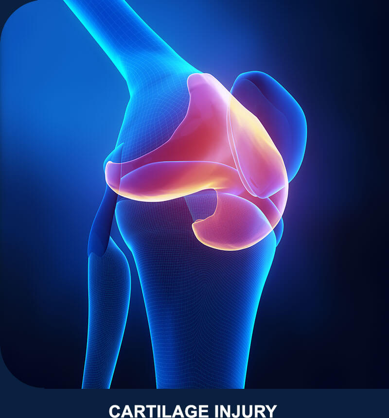 Anatomy – Cartilage Injury