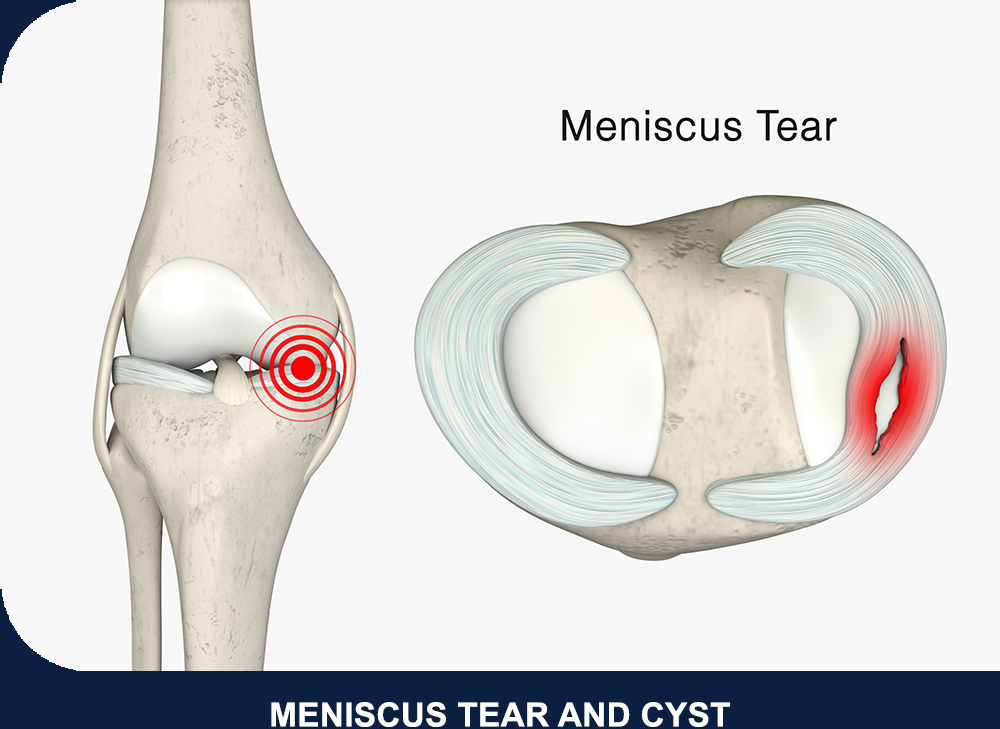 Meniscus Tear Treatment in Singapore Quantum Orthopaedics
