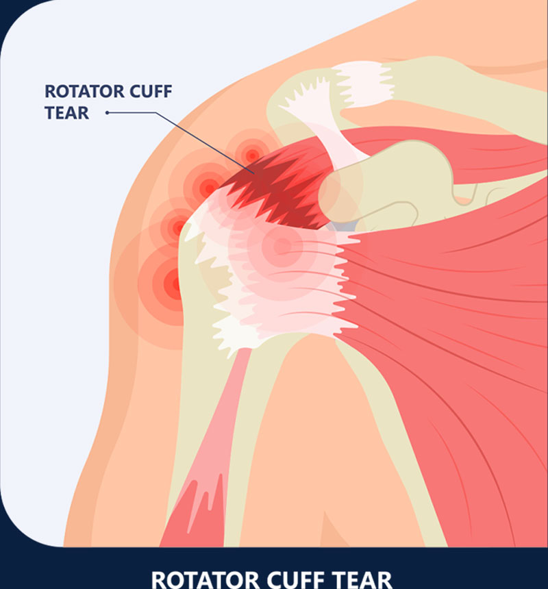 Anatomy – Rotator Cuff Tear