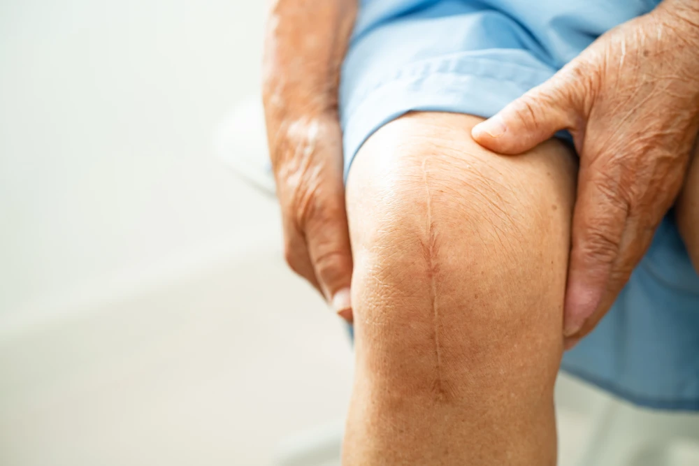 Asian elderly woman patient with a surgical scar after total knee replacement surgery